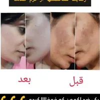 درمان لک ومشکلات پوستی|آرایشی، بهداشتی، درمانی|رشت, کوی جام جم|دیوار