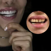 افر تابستانه کامپوزیت دندان متریال در جه یک .|خدمات آرایشگری و زیبایی|کرج, گلشهر|دیوار