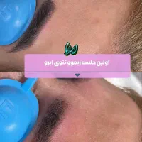 ریموو(پاککردن)تتو ابرو با لیزر تخفیف50درصد(ایرانا
