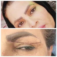 ژل بوتاکس بلفارو پلاستی لیزر|خدمات آرایشگری و زیبایی|اهواز, اهواز|دیوار