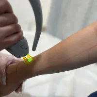 لیزر موهای زائد الکساندرایت کندلا دکتر منتظری|خدمات زیبایی و سلامت|قم, صادقی|دیوار