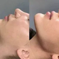 ژل و بوتاکس فیلر چربی مزو|خدمات آرایشگری و زیبایی|مشهد, طلاب|دیوار