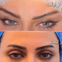 *آخرین تخفیف*عمل لیپو و ابدو و پیکرتراشی و لیفت|خدمات آرایشگری و زیبایی|کرج, گلشهر|دیوار