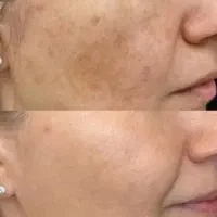 فشیال ورفع تیرگی بدن