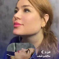 ساکشن غبغب