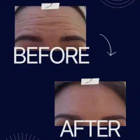 فیلر،بوتاکس،مزوتراپی،عصاره سلول بنیادی توسط پزشک