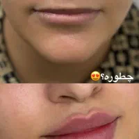تزریق بوتاکس و فیلر و انزیم و پی ارپی وانواع نخ ها|خدمات آرایشگری و زیبایی|مشهد, رضاشهر|دیوار