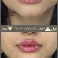 تزریق حرفه ای فیلر در کلینیک زیبایی و لیزر راویس|خدمات آرایشگری و زیبایی|کاشان, رجایی|دیوار