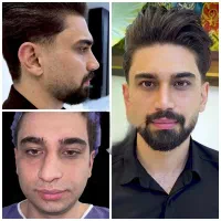 جراحی بینی لیفت سینه لیپومامو ژنیکو پیکر ابدوپروتز|خدمات آرایشگری و زیبایی|تهران, علم و صنعت|دیوار