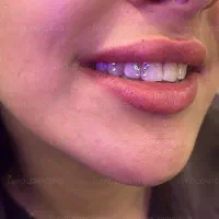 پیرسینگ و نگین دندان تخصصی در کلینیک پرستاری