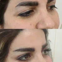 ژل بوتاکس بلفاروپلاستی لیفت شقیقه ساکشن غبغب