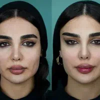 لیفت فول فیس صورت و شقیقه بدون عمل جراحی