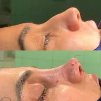 عمل بینی با هزینه باورنکردنی ویژه آذر ماه