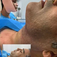 فقط ( ۱۰میلیون ) لیپوغبغب و بوکال فت،جراح پلاستیک