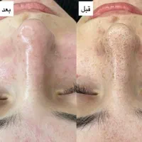 جشنواره فشیال تخصصی با ۵۰٪ تخفیف فقط برای ۵ نفر|خدمات آرایشگری و زیبایی|یزد, |دیوار