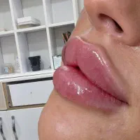 ژل بوتاکس خالبرداری