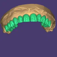 عصبکشی پر کردن ۱۳۰۰ روکش فروش رادیوگرافی|خدمات آرایشگری و زیبایی|مرند, |دیوار