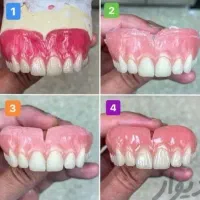 پروتز متحرک(دندان مصنوعی)