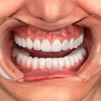 لمینیت دندان هالیوودی|خدمات آرایشگری و زیبایی|اصفهان, خواجو|دیوار