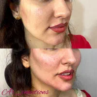 آموزش و تزریق ژل و بوتاکس|خدمات آرایشگری و زیبایی|مسجد سلیمان, |دیوار