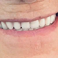 دندانسازی/پروتز متحرک/دندان مصنوعی/دست دندان|خدمات آرایشگری و زیبایی|کرج, برغان|دیوار