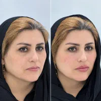 دوره آموزشی ژل و بوتاکس