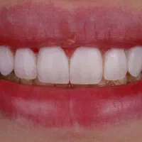 کامپوزیت ونیر دندان بهترین کیفیت رایگان