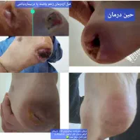 درمان قطعی پسوریازیس ویتیلیگو زخم بستر