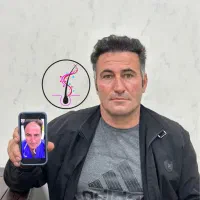 کاشت مو فول تراکم تضمینی اقساطی