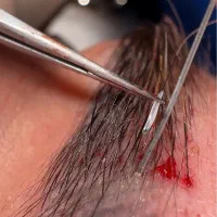 کاشت ابرو/میکرو