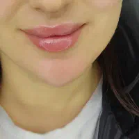 تزریق ژل و بوتاکس، پی ار پی،  نخ صورت