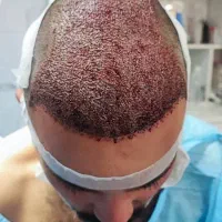 کاشت موی طبیعی|خدمات آرایشگری و زیبایی|شیراز, قدوسی شرقی|دیوار