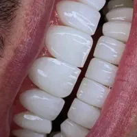 کامپوزیت بدون پیش پرداخت در یک جلسه