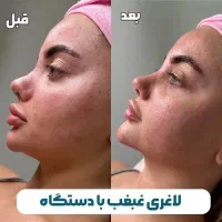 پیکرتراشی و...بدون جراحی نتیجه تضمینی دراولین جلسه