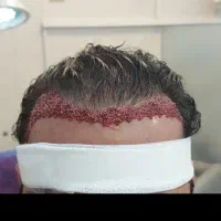 کاشت مو توسط مادر کاشت ایران