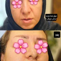 چهره‌ای که عاشقش میشی،بوتاکس،ژل وفیلر توسط متخصص|خدمات آرایشگری و زیبایی|ارومیه, |دیوار