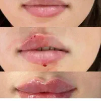 آف ویژه تخلیه و تزریق چربی ،ساکشن،ژل،بوتاکس