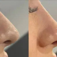 تخفیفات خدمات زیبایی فیلر بوتاکس نخ لیزر پاکسازی|خدمات آرایشگری و زیبایی|یزد, |دیوار