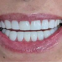 کامپوزیت دندان با برندهای معتبر جهانی