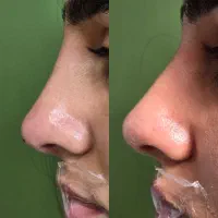 تخفیف ژل و بوتاکس فیلر