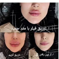 ژل بوتاکس فیلر آنزیم خالبرداری با تخفیف ویژه|خدمات آرایشگری و زیبایی|تهران, سبلان (لشگر)|دیوار