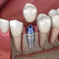 ایمپلنت دندان سوئیسی|آرایشی، بهداشتی، درمانی|تهران, قیطریه|دیوار