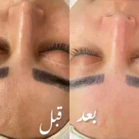 فیشیال و پاکسازی تخصصی پوست|خدمات آرایشگری و زیبایی|قم, قلعه کامکار|دیوار