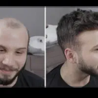 پروتز مو و ترمیم مو