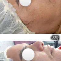 مدل برای روشن سازی صورت و از بین بردن جوش|خدمات آرایشگری و زیبایی|مسجد سلیمان, |دیوار