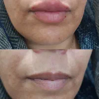 ژل و بوتاکس و برداشتن خال|خدمات آرایشگری و زیبایی|اهواز, زرگان|دیوار