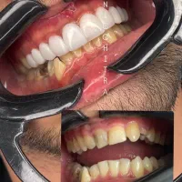 جشنواره کامپوزیت دندان/لیرینگ/لمینت/روکش /اقساط