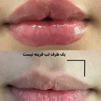 لیزر هایفو ژل بوتاکس ریمو تتو