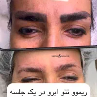 آموزش تخصصی ریموو تتو با مدرک معتبر