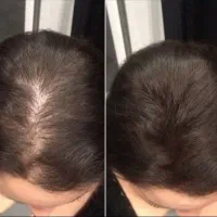 درمان قطعی ریزش مو